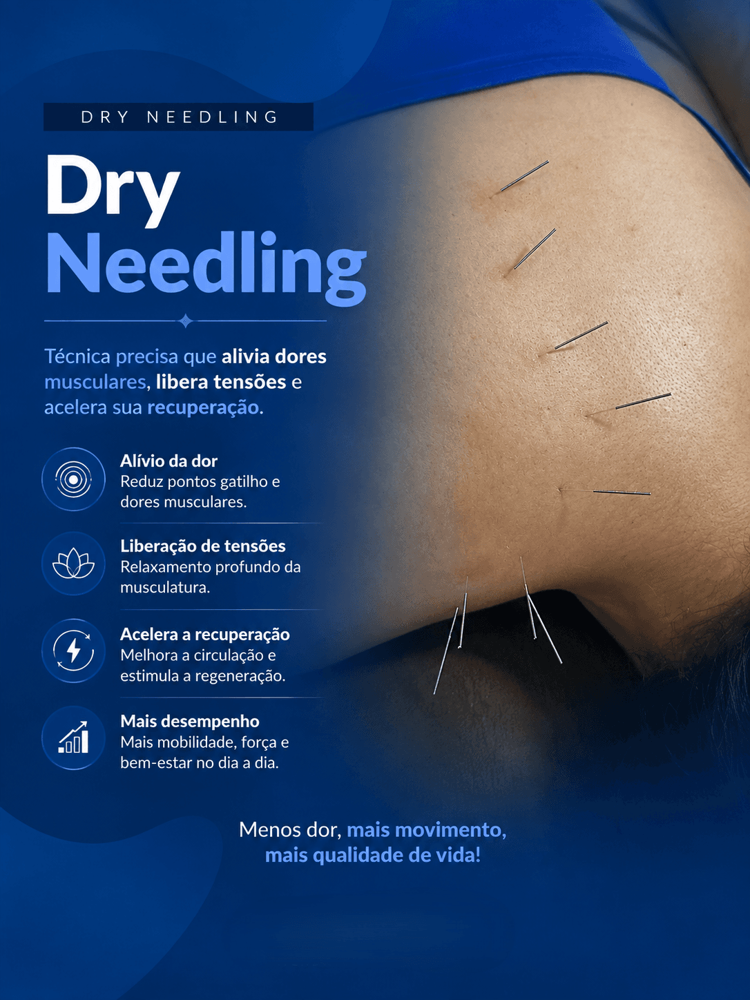 Dry needling