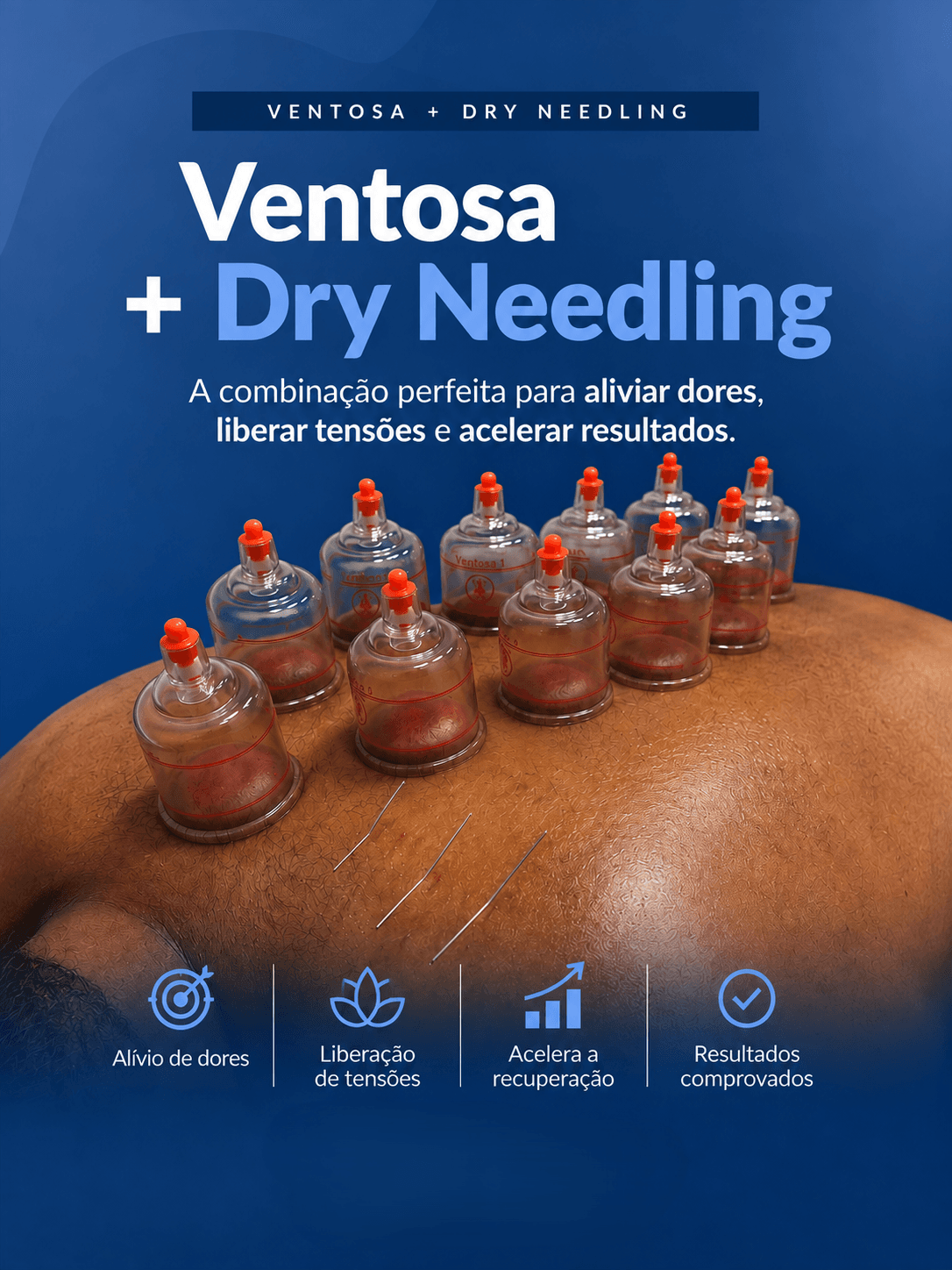 Ventosa + Dry Needling